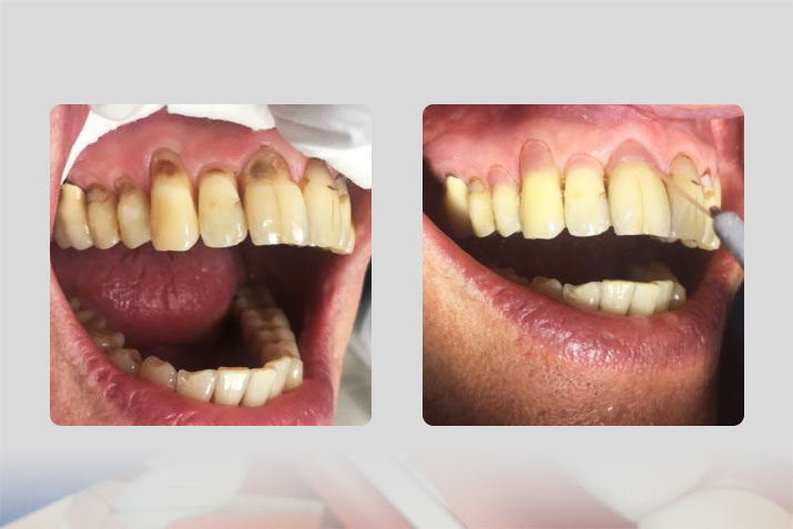 Beispiel für Zahnhalsfüllungen 